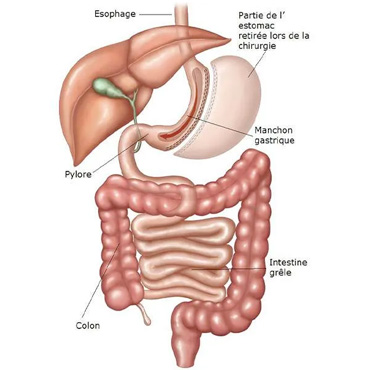 Proc Dures Ma Chirurgie Bariatrique